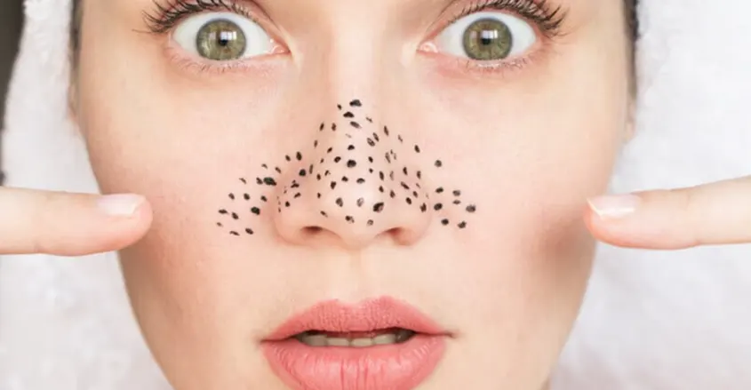 Mujer con puntos en la piel de la cara