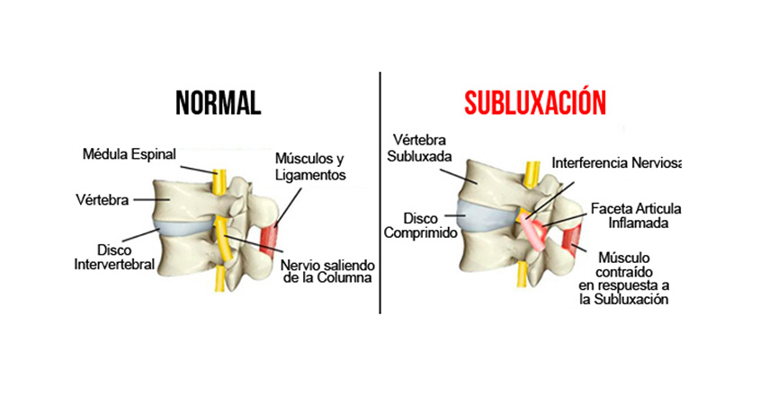 Imagen de subluxacion quiropractico Barcelona